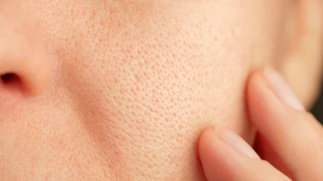 How to Get Rid of Blackheads? Easy Step-by-Step Guide