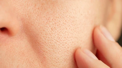 How to Get Rid of Blackheads? Easy Step-by-Step Guide