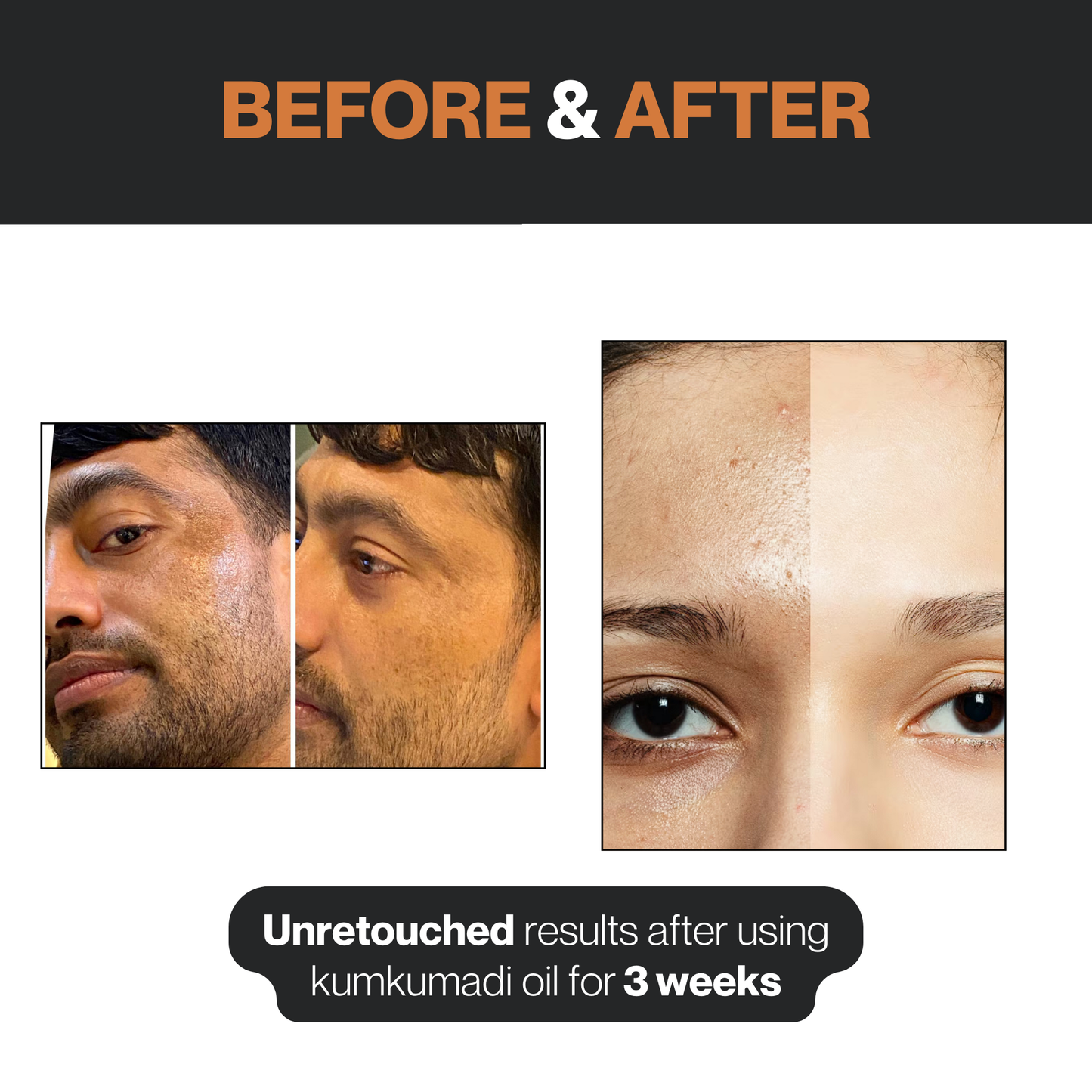 Kumkumadi Face Oil for Glowing Skin - 15 ML || Enhances Glow | Evens Skin Tone | Nourishes Deeply